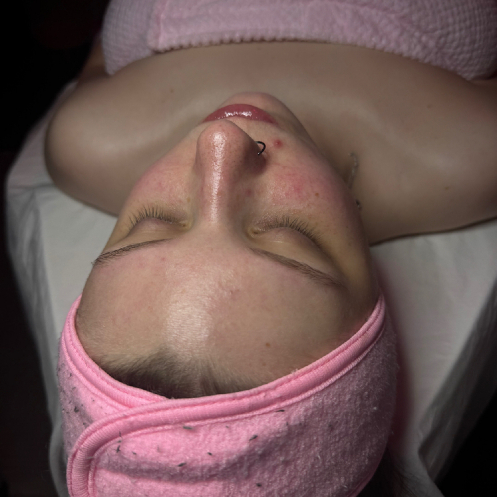 Acne Fighting at Glam by K in Logan, WV