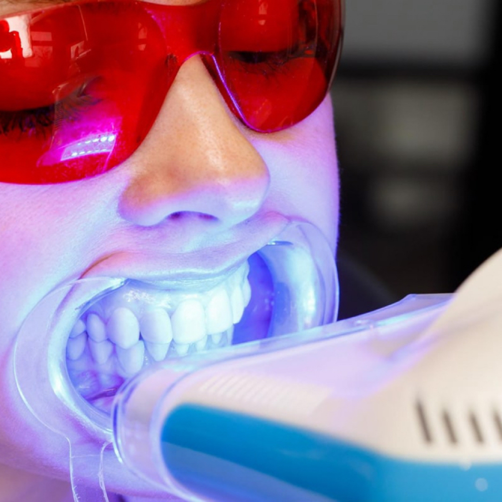 Teeth Whitening at Enhanced Beauty by Irma in Houston, TX