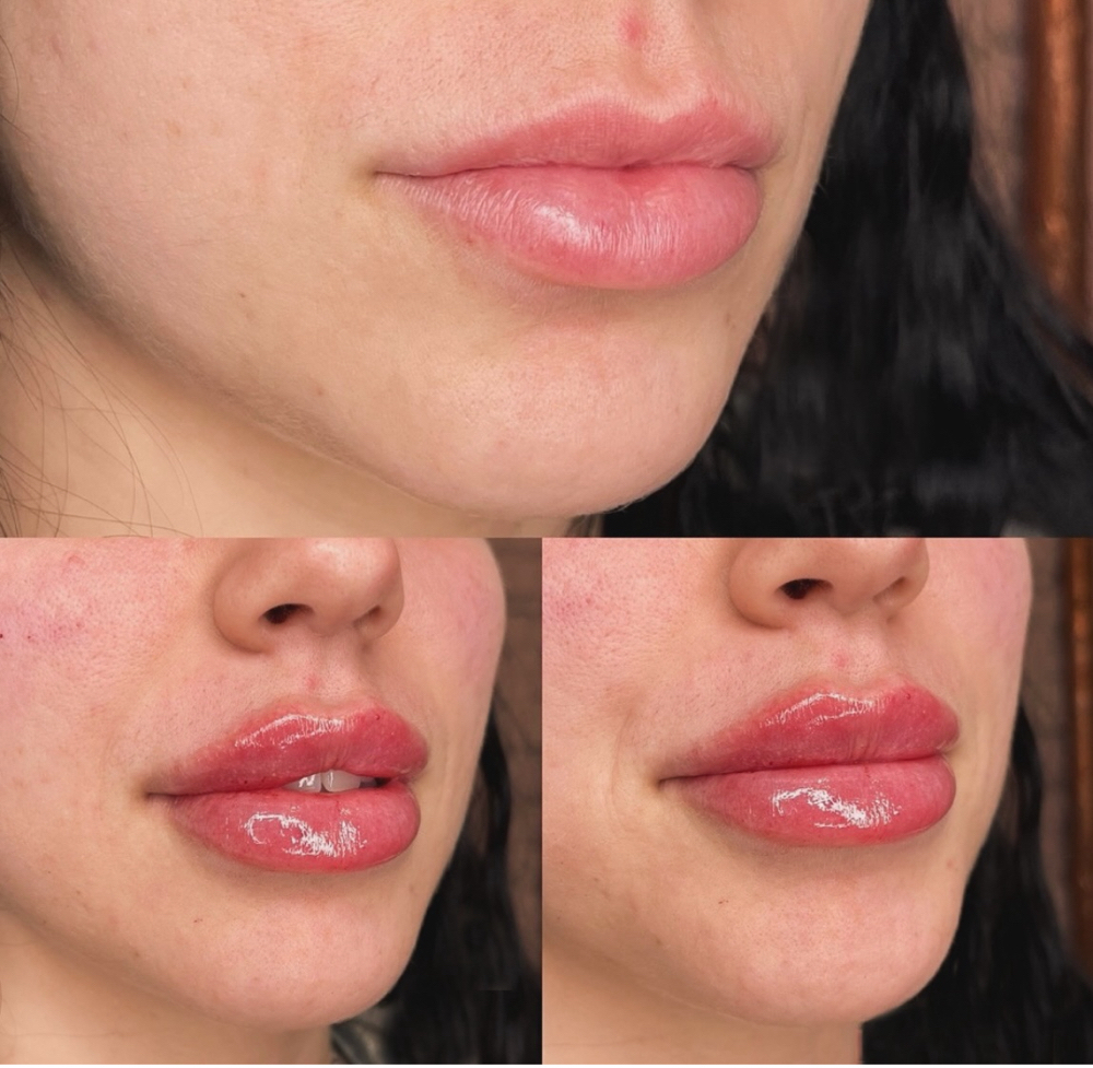 Full Lip Filler