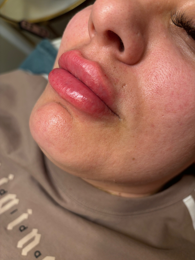 2ML (Mega Plumped)