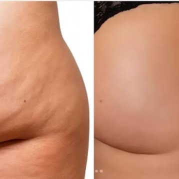 Cellulite Massage Treatment at RelaxRx Mobile Massage