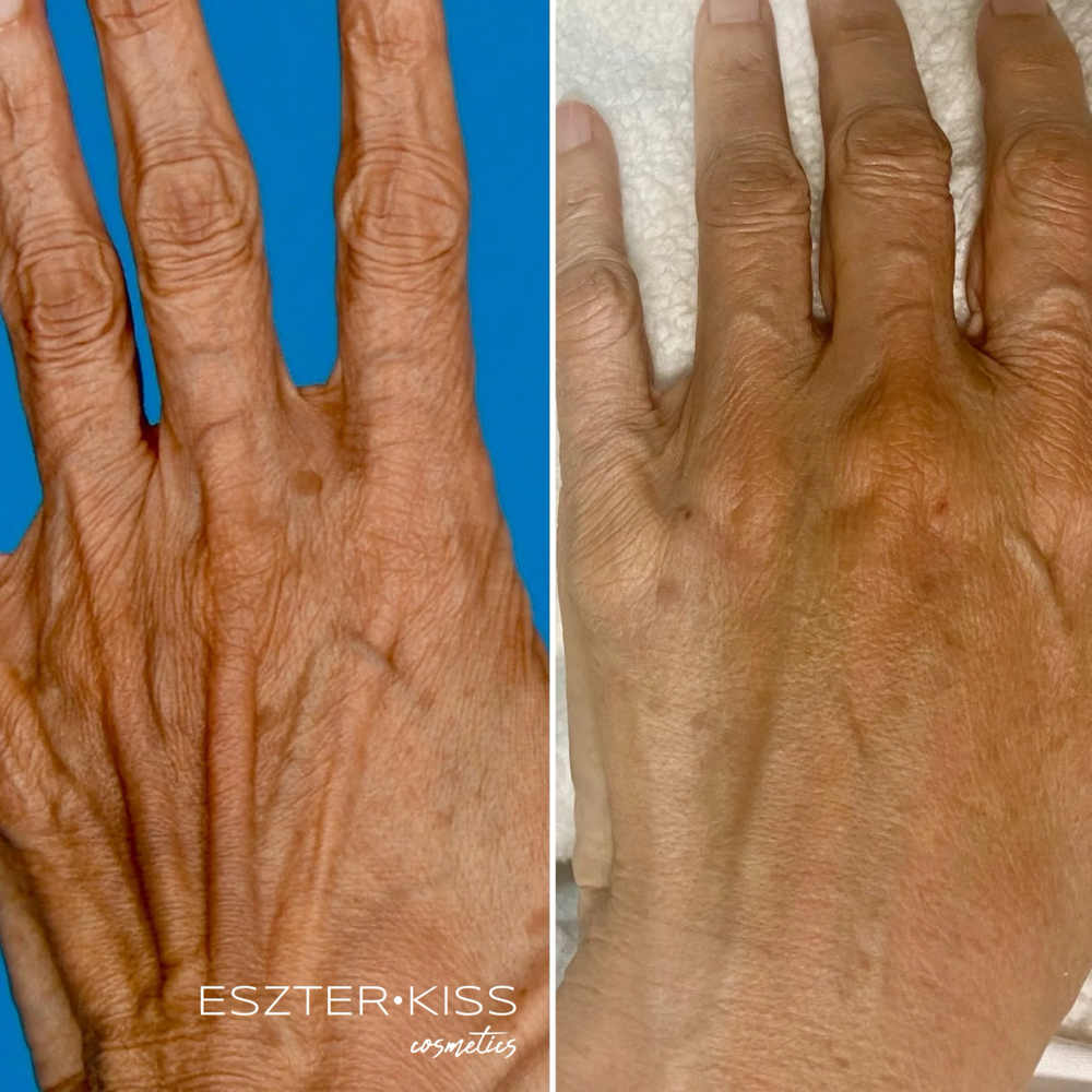 Hand Rejuvenation – Plasma Fusion at Eszter Kiss Cosmetics in Deltona, FL