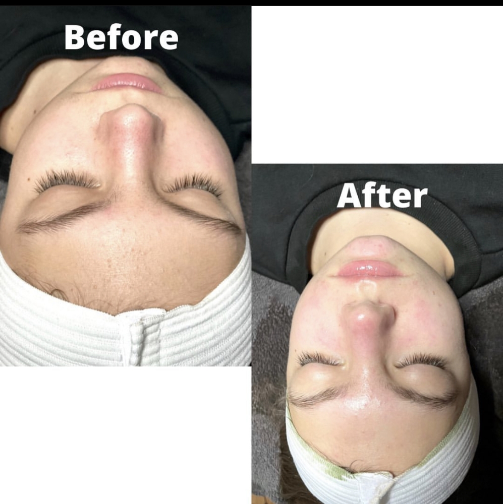 Teen Facial