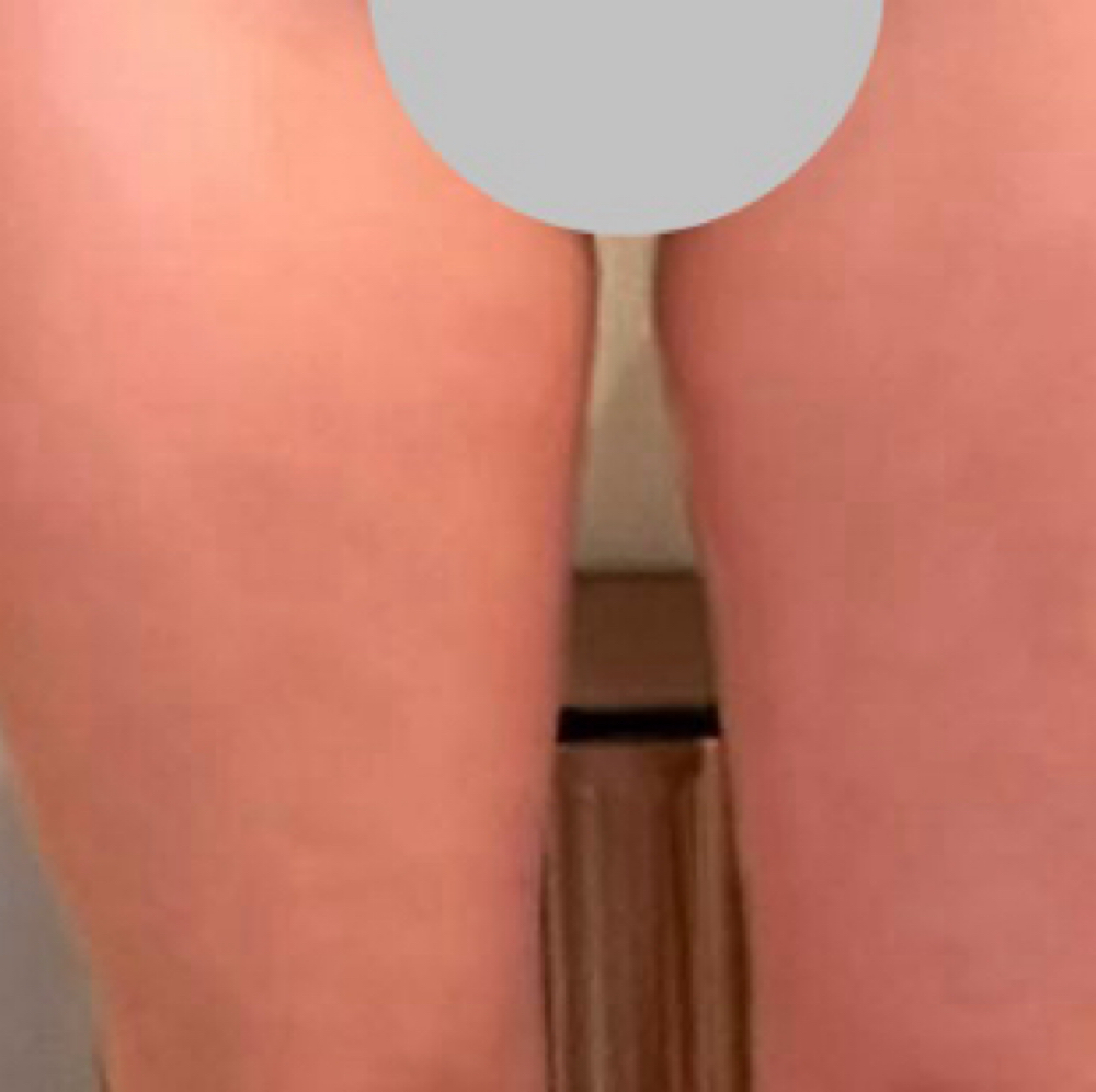 Inner thigh 3-session bundle at Silhouette Body Sculpting LLC in St. Peter’s, MO