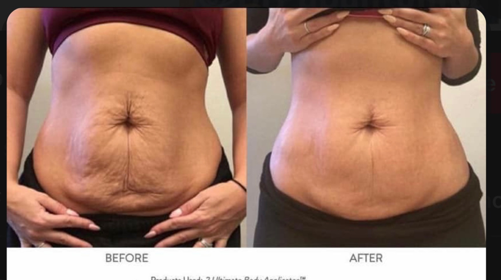 Skin Tightening Treatment