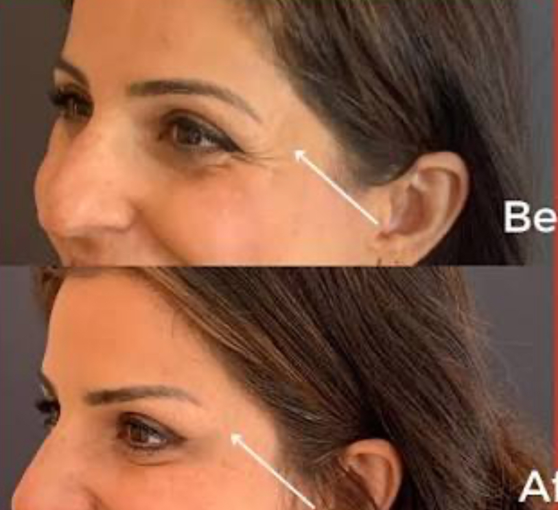Botox Brow Lift