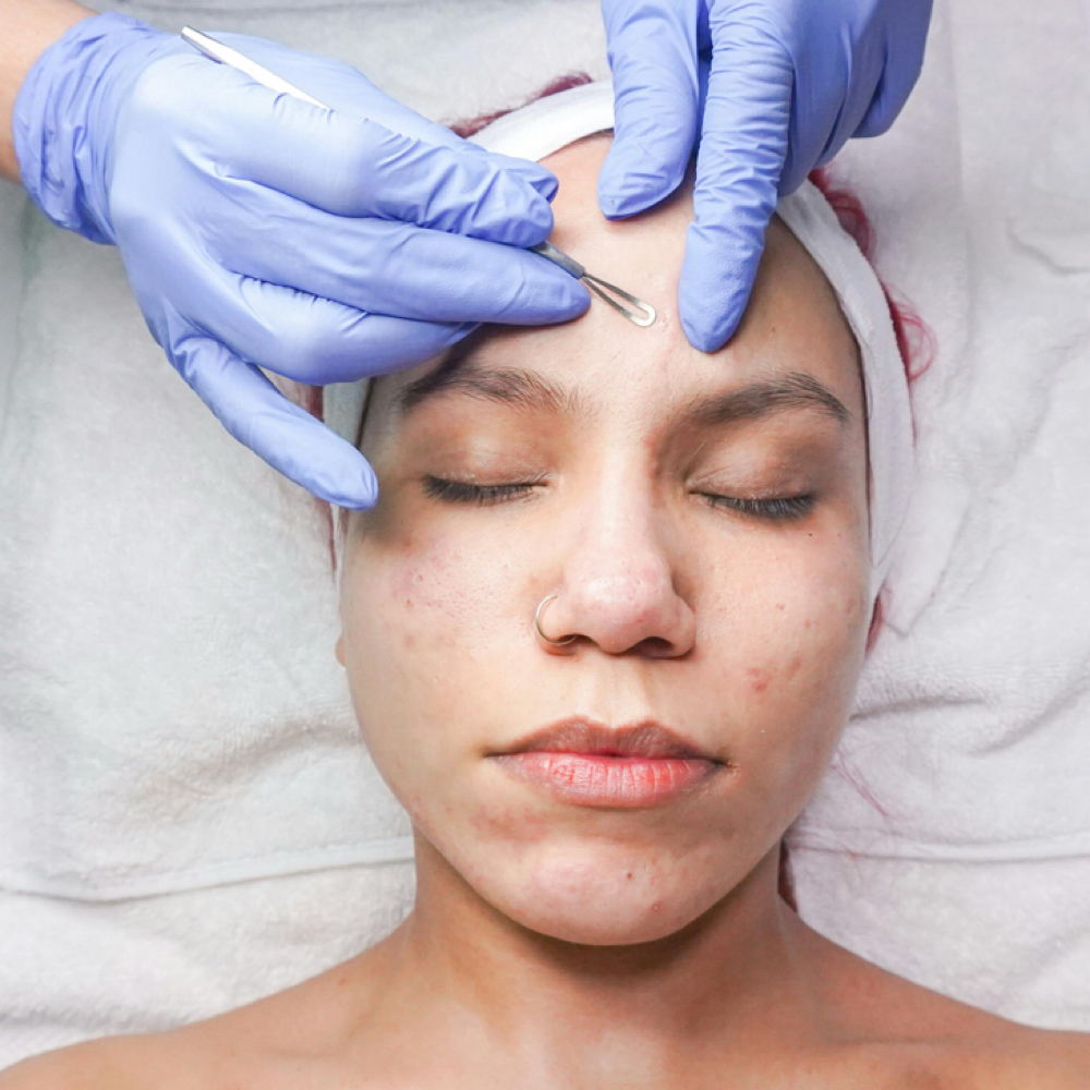 Clarifying Facial with Extractions at Dermalove Aesthetics in Portland, OR