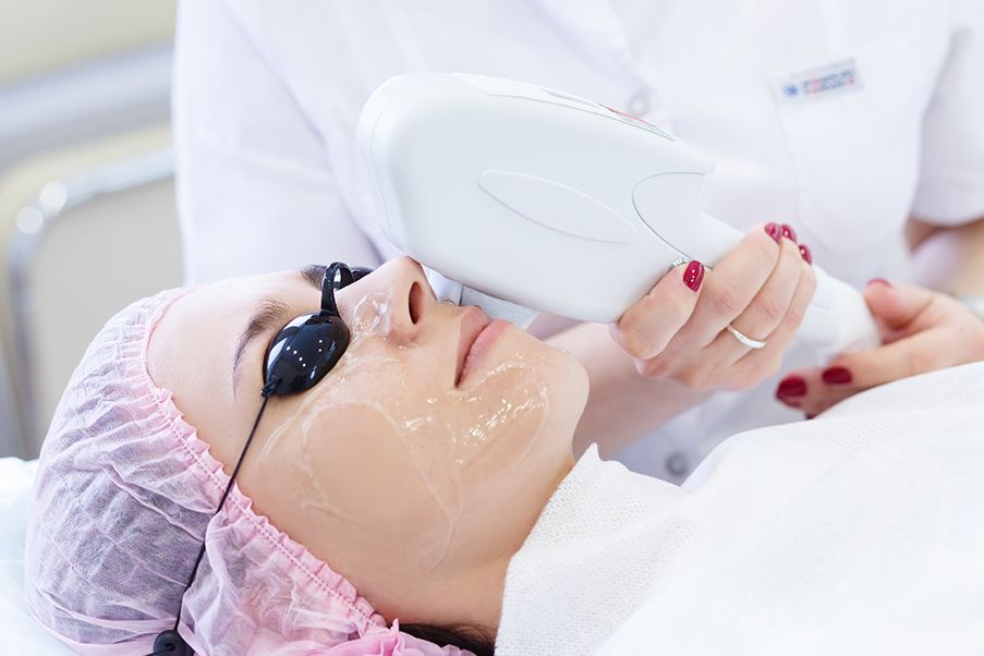 IPL Pigmentation Treatment