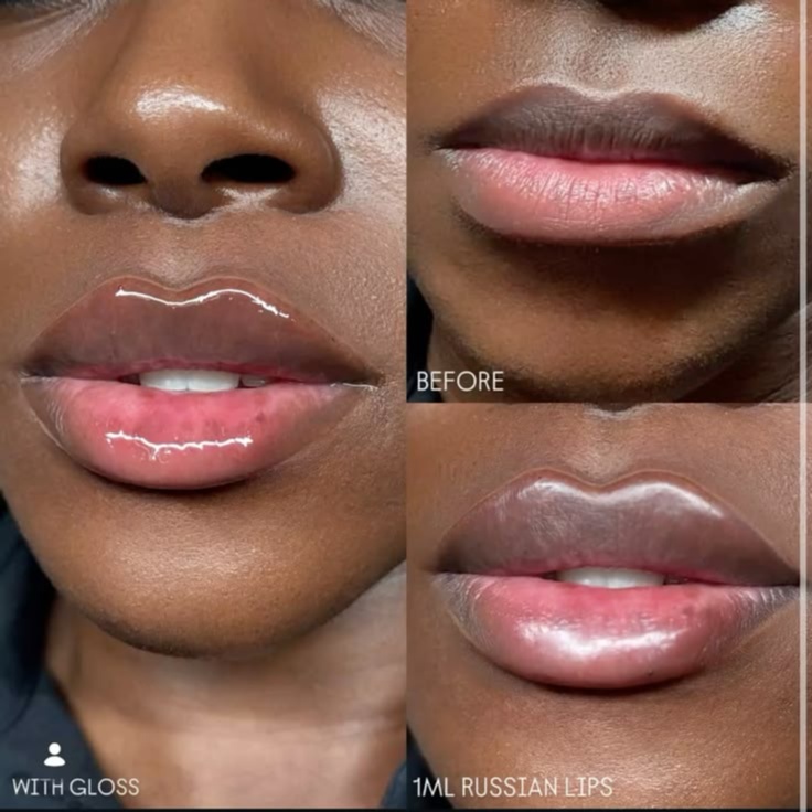 Lip Filler (Needleless) at Ming’s Lashes and Spa in Des Moines, IA