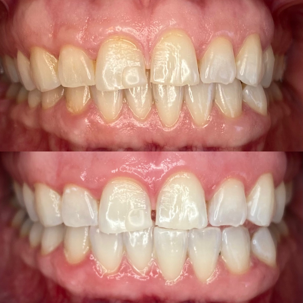 Advanced Teeth Whitening