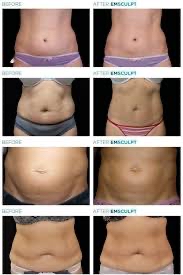 CAVITATION Body Sculpting