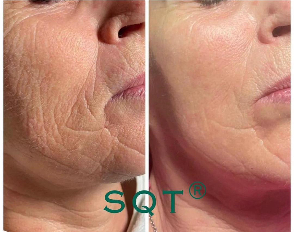 BioMicroneedleing Tmt