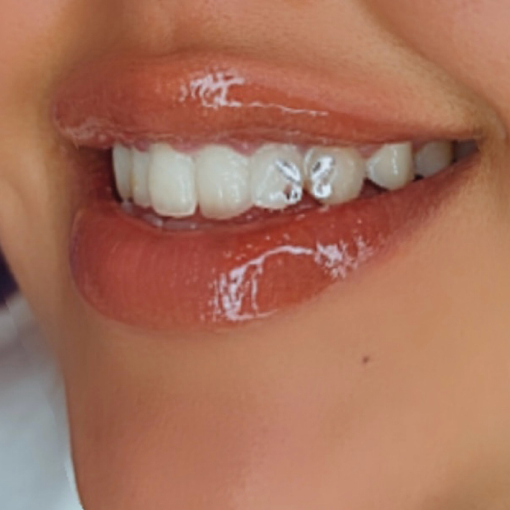 Teeth Whitening at Doll’d Up Beauty in Madera, CA