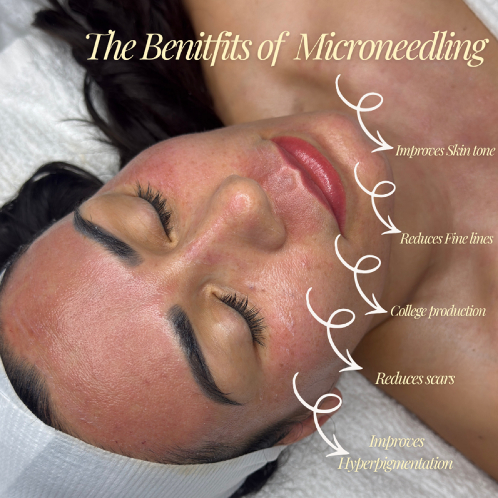 Microneedling 4 - Treament Plan at The Beauty Series in Mesa, AZ