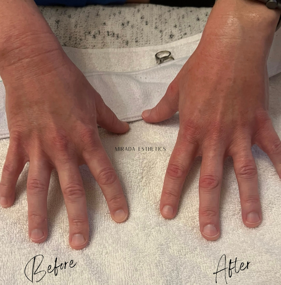 Mini Hand Facial at Mirada Esthetics in Franklin, TN
