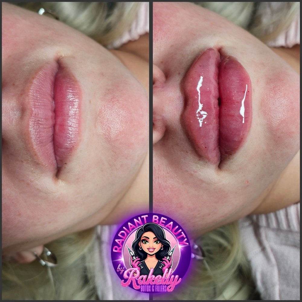 1 Ml of Selected Lip Filler at Radiant Beauty By Rakelly LLC in Fort Worth, TX