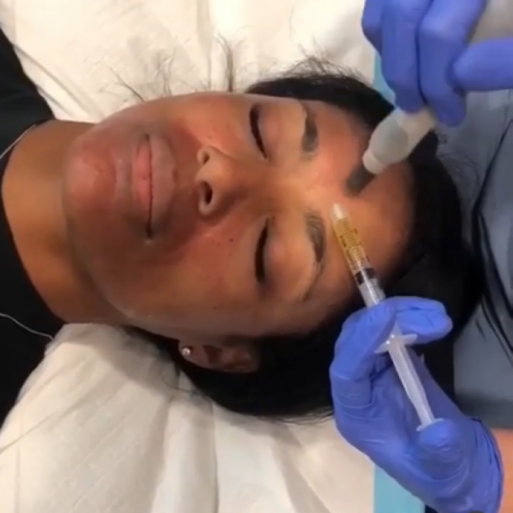 Microneedling With Growth Factors at Cosmetic Artistry in Lancaster, CA