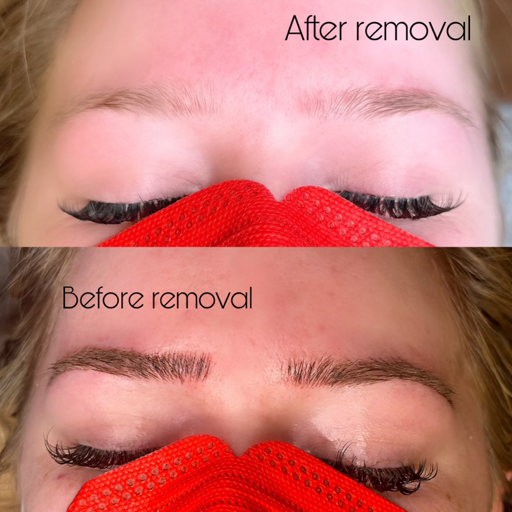 PMU Tattoo Removal