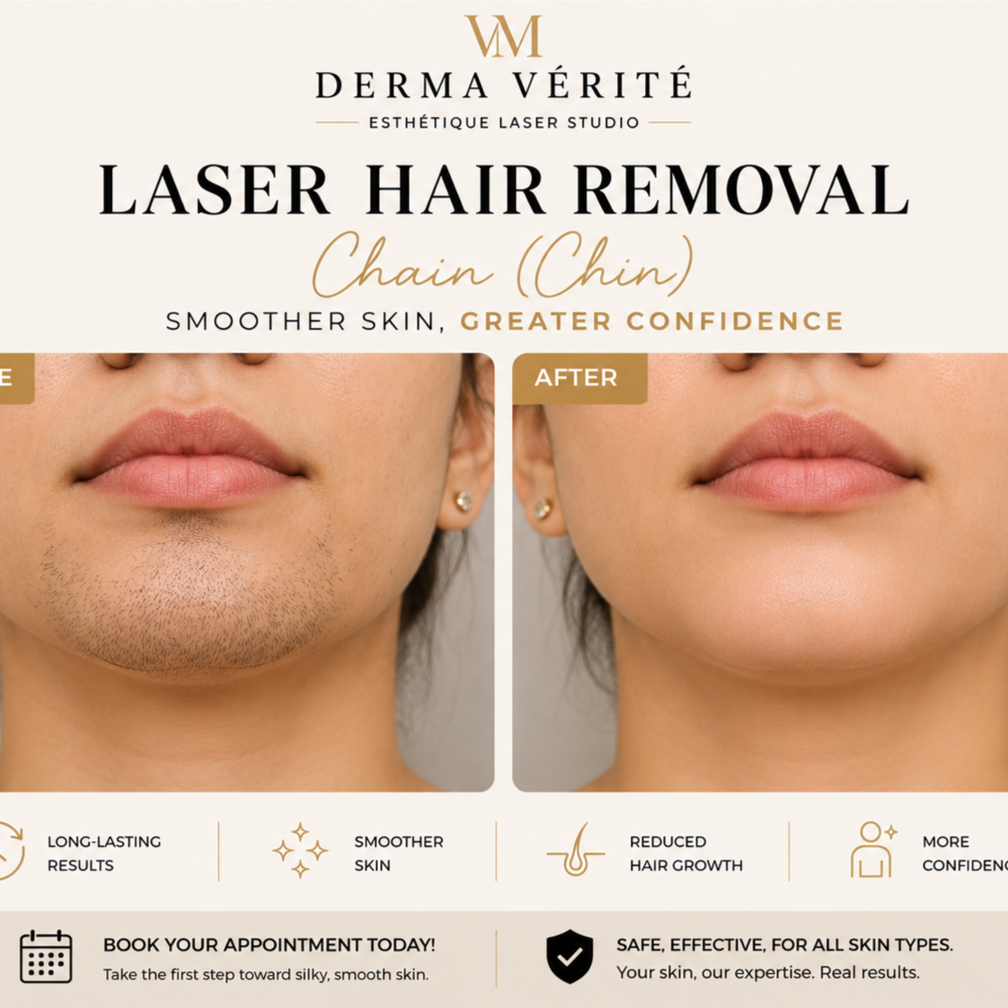 Laser Hair Removal (Chin) at Derma Verite Esthetique Laser Studio in Elmhurst, NY