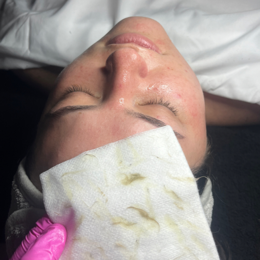C.F. w/ dermaplane at Bae's Beauty Esthetics in Milan, TN