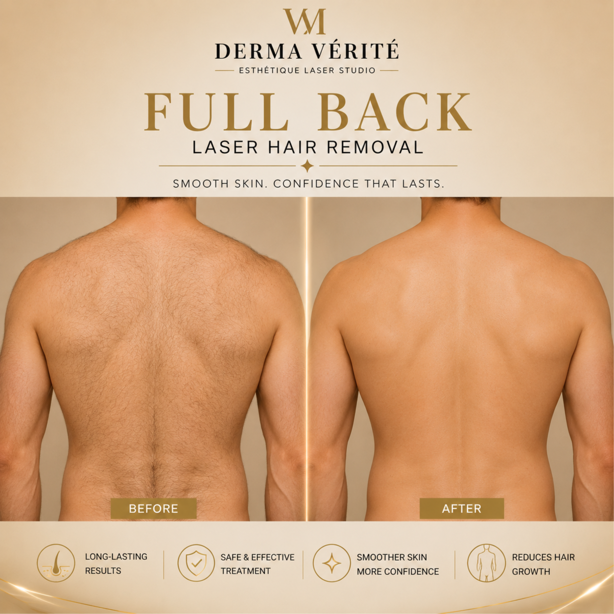 Full Back Laser Hair Removal at Derma Verite Esthetique Laser Studio in Elmhurst, NY