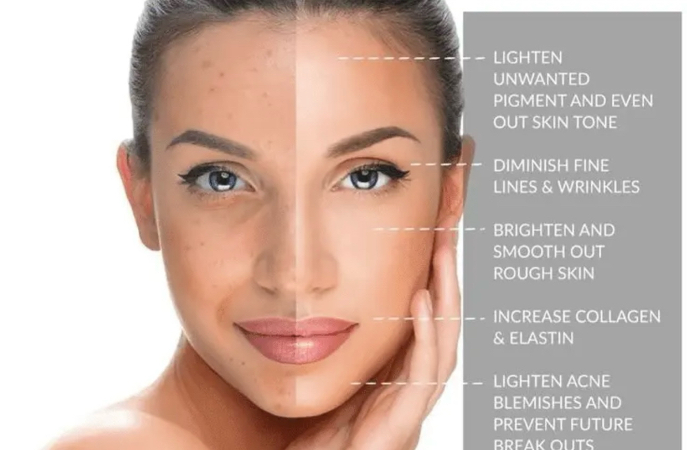 Chemical Peel