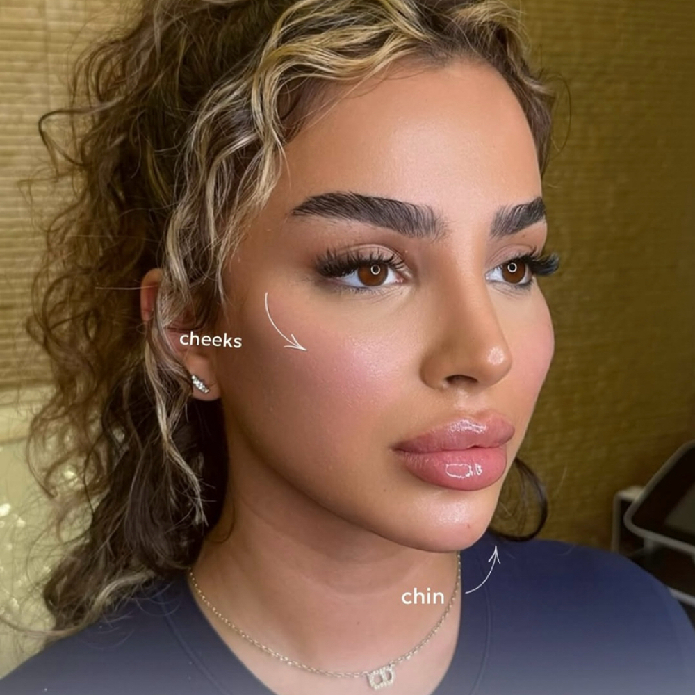 Sculptra at Aesthetics by Amina in New York, NY