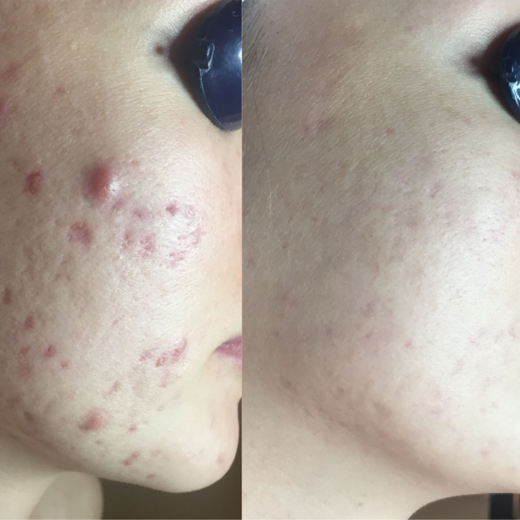 Acne Scar Repair at Ingrid Thompson Skincare in Beverly Hills, CA
