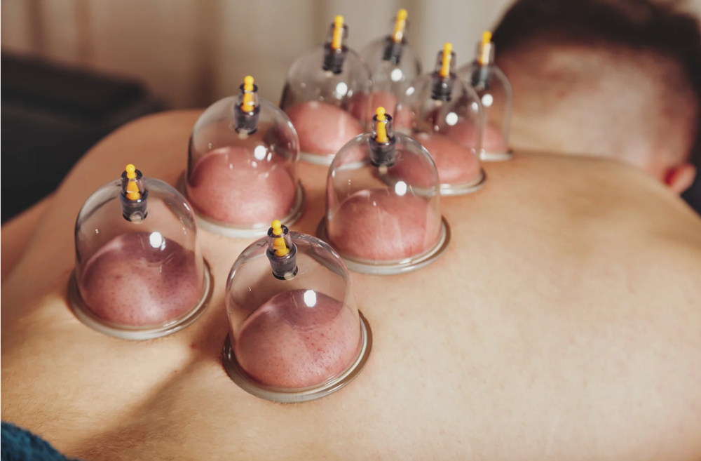 Cupping