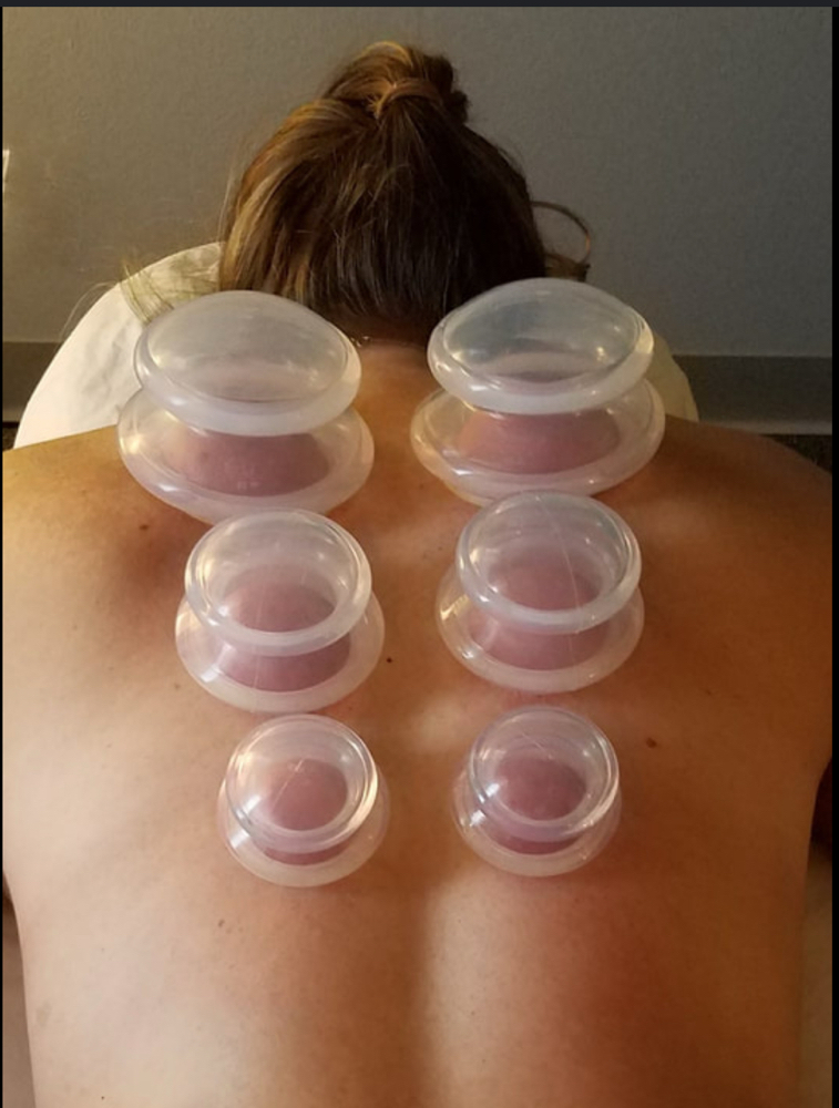 Cupping