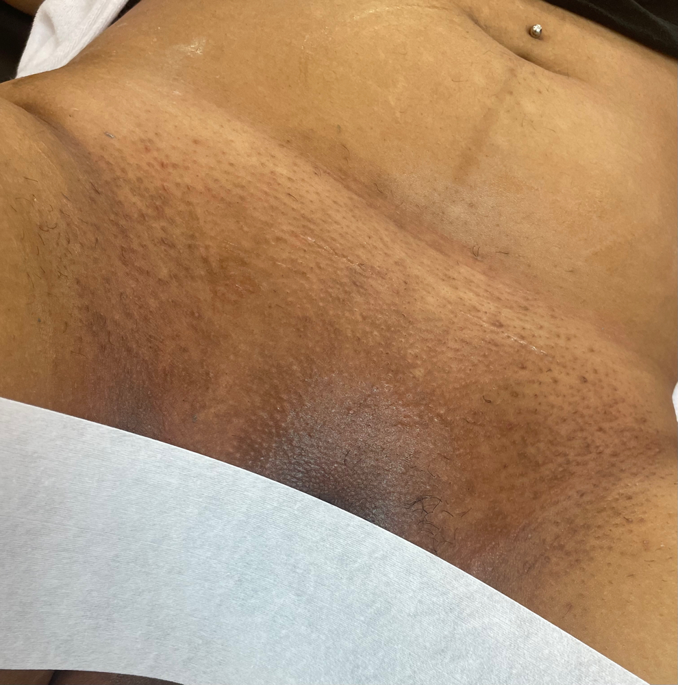 Brazilian Wax at Runway Esthetics in Racine, WI