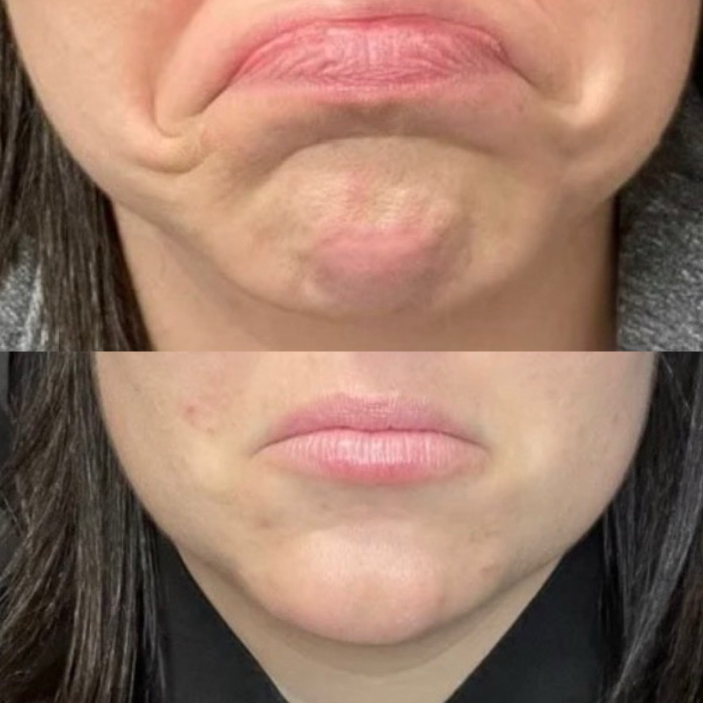 Tox-DAXXIFY DAO Smile Lift