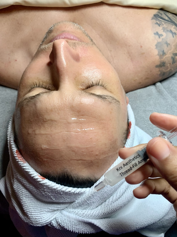 Nano Collagen Threadlift Facial