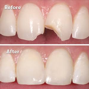 Composite Veneer Repair at BG Cosmetic in Inglewood, CA