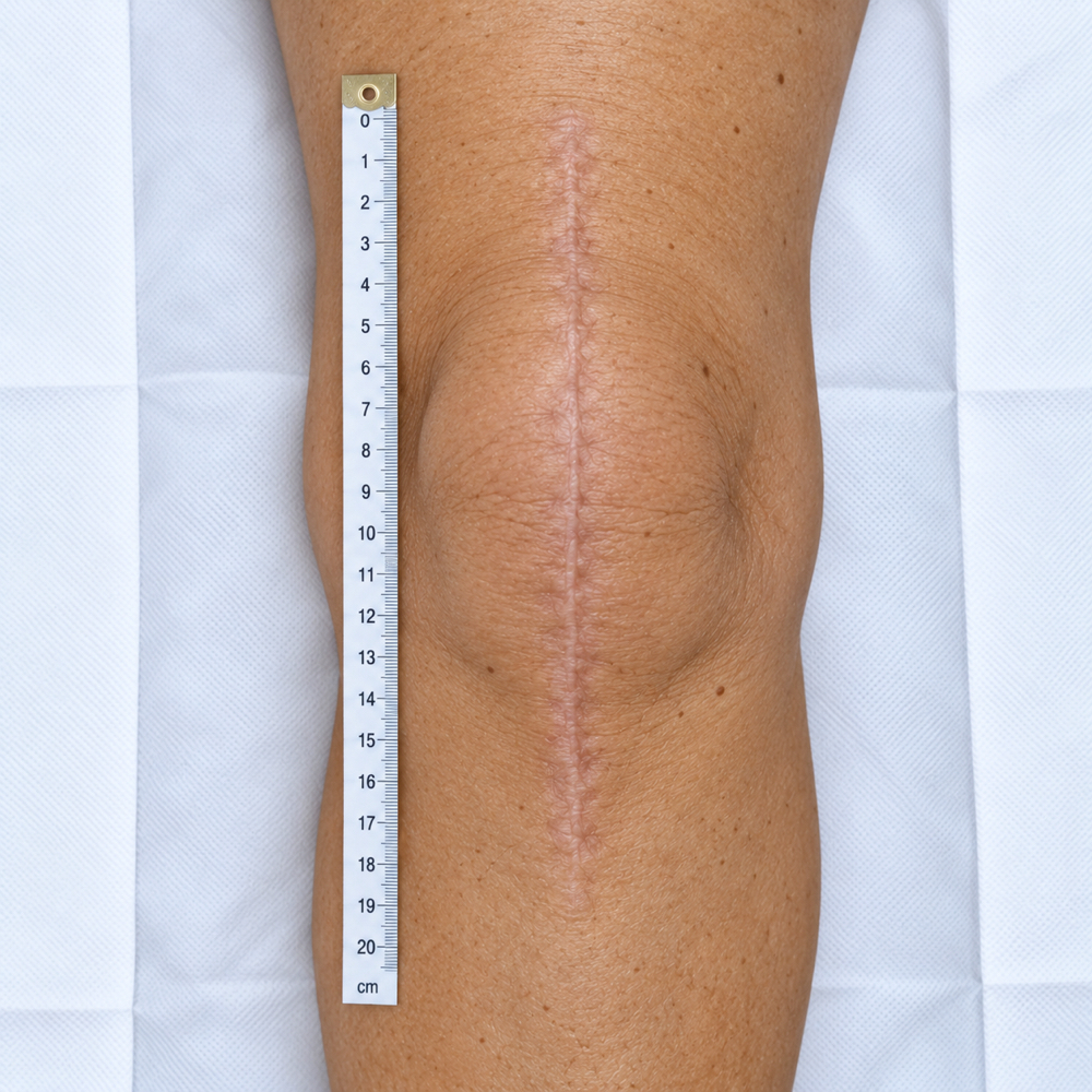 Large or Complex Medical Scars at Fine Arches in Woodside, NY
