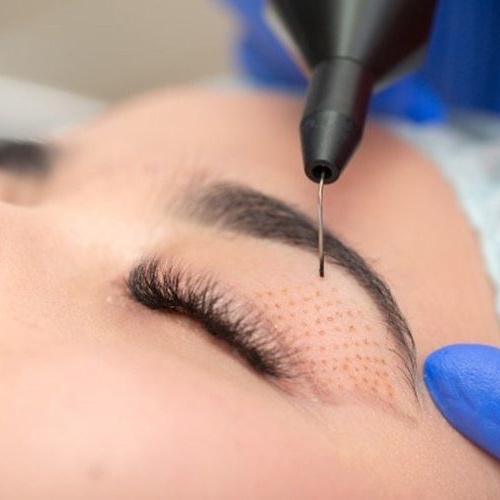 PLASMA FIBROBLAST  FULL EYES at Remake Beauty Studio Mission in Mission, TX