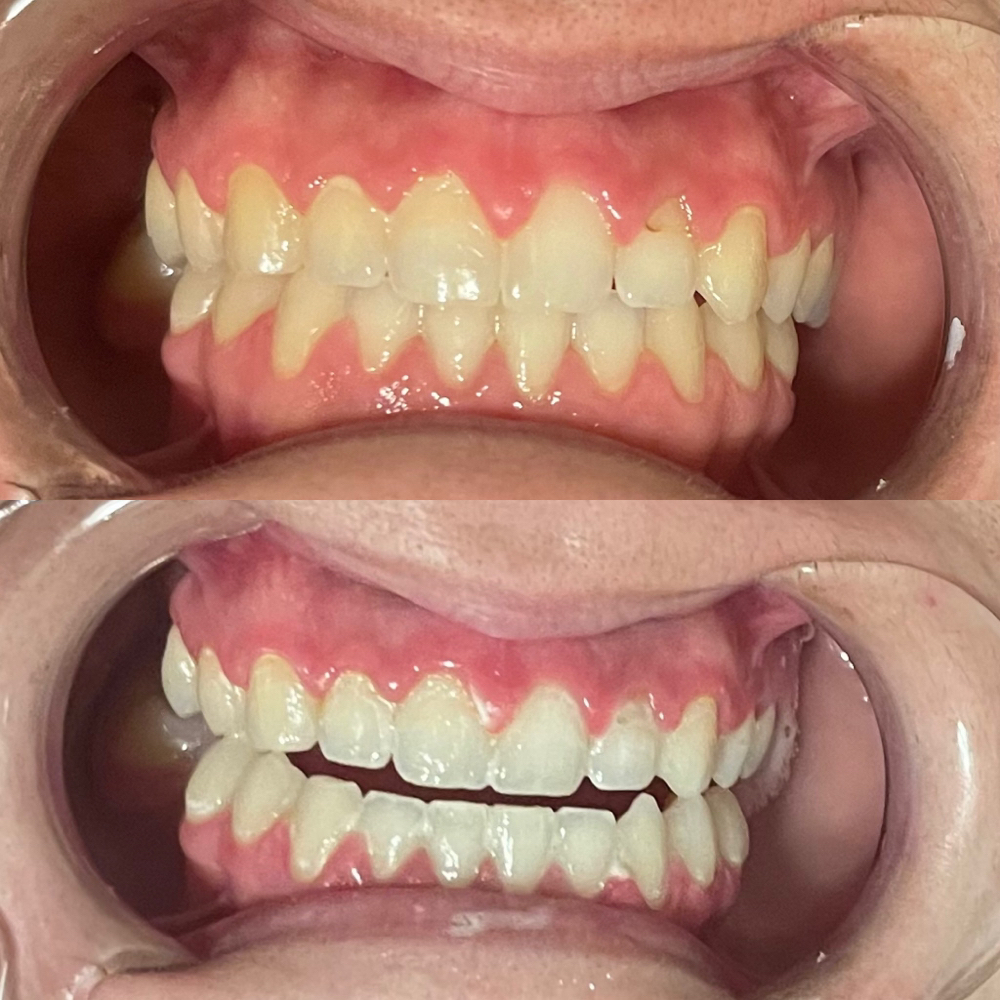 Teeth Whitening