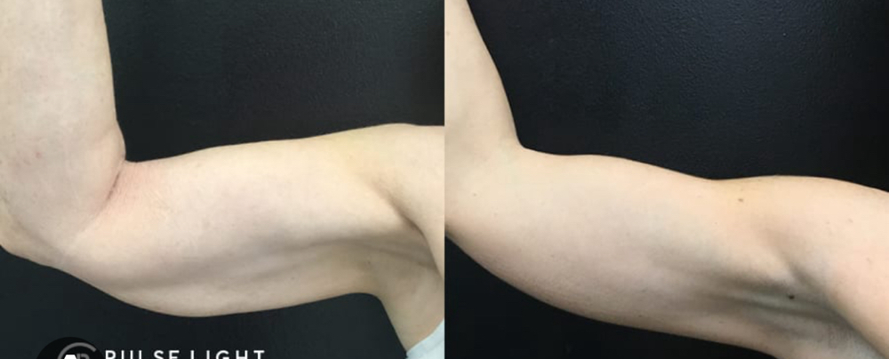 Upper Arms Sculpt Fat loss Cryo Med at VINE Studios Permanent Cosmetics in Maple Valley Wa, WA