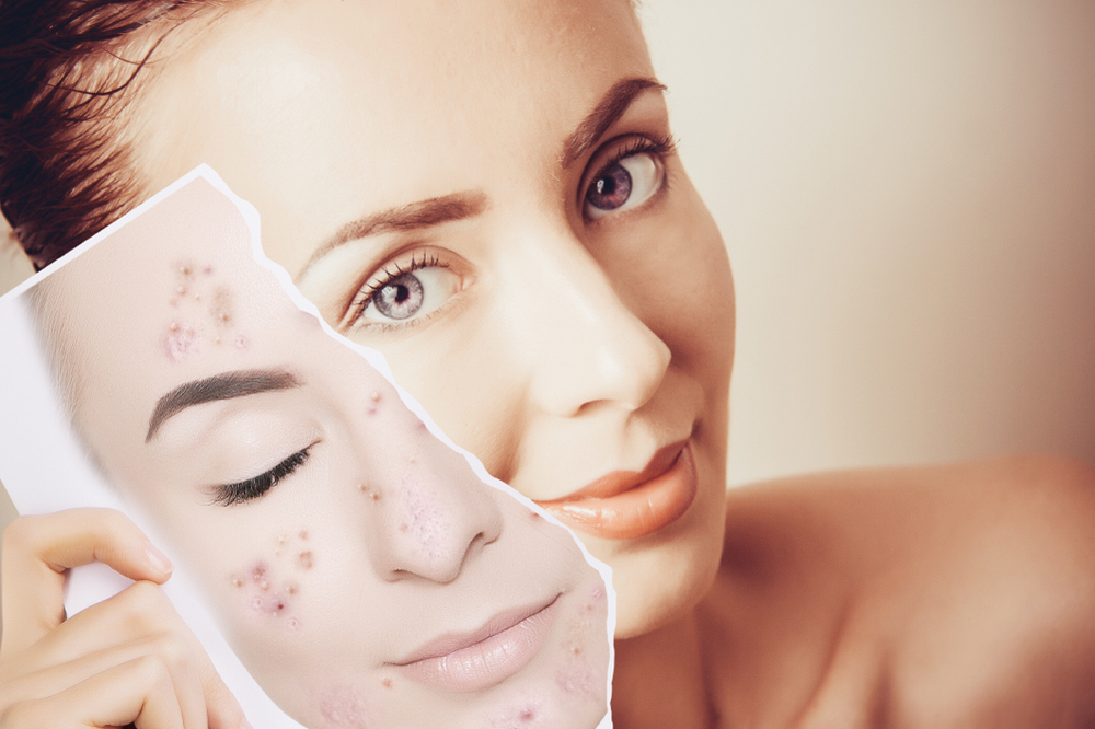 Acne Peel Package Of 4