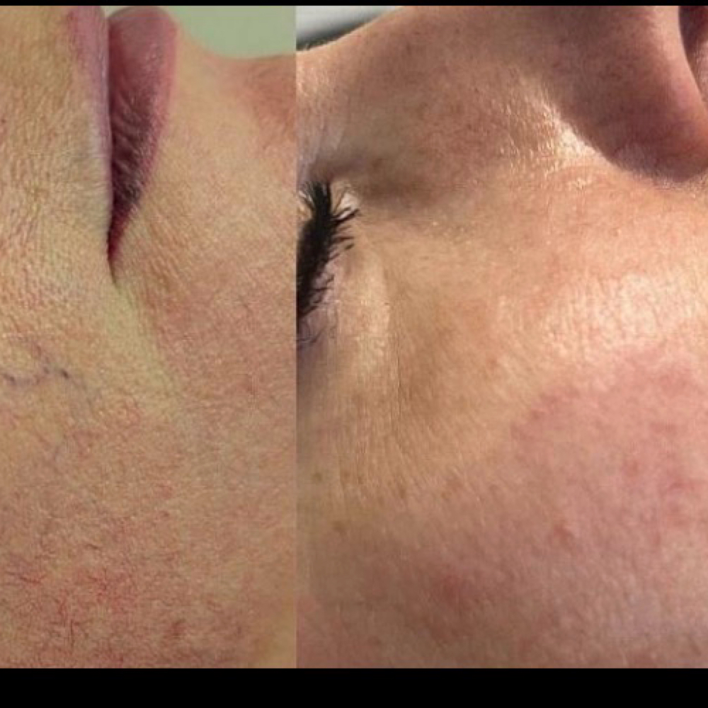 Vascular Veins (6) at La Belle Studio by Soraya in Woburn, MA
