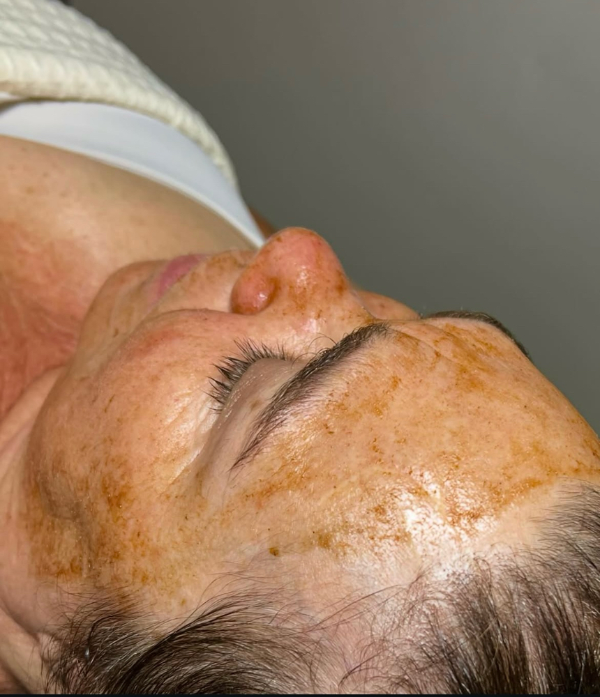 Custom Peel Treatments