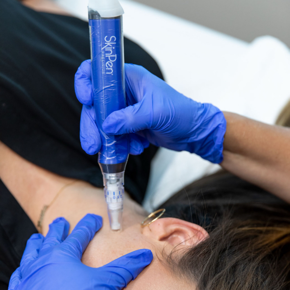 Microneedling Package Purchased at Anfissa Beauty in Mount Angel, OR