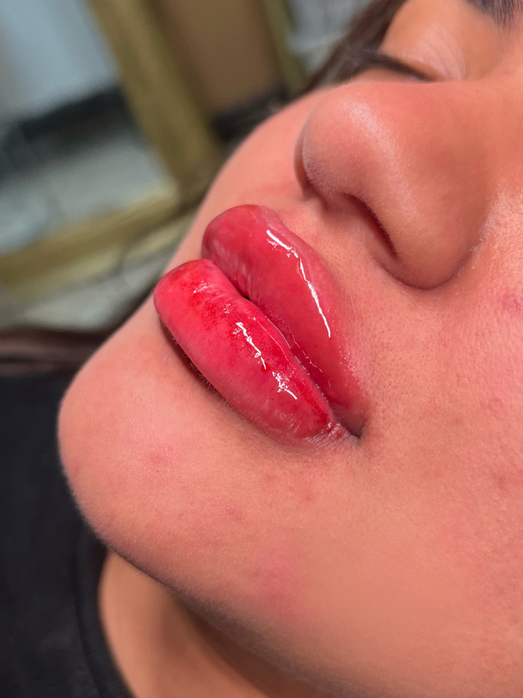 Lip Fillers