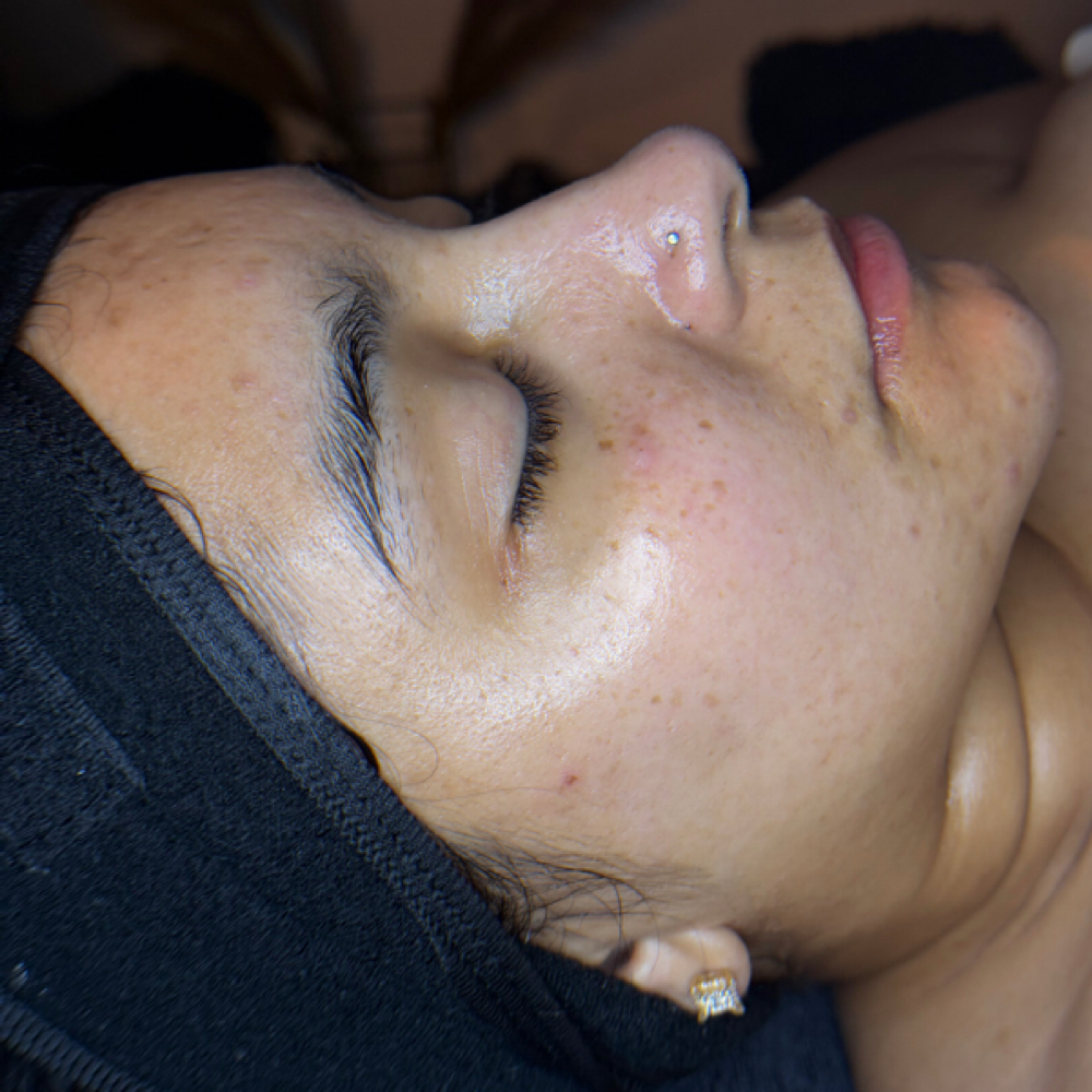 Dermaplane Facial at Glogetteresthetics in Warwick, RI