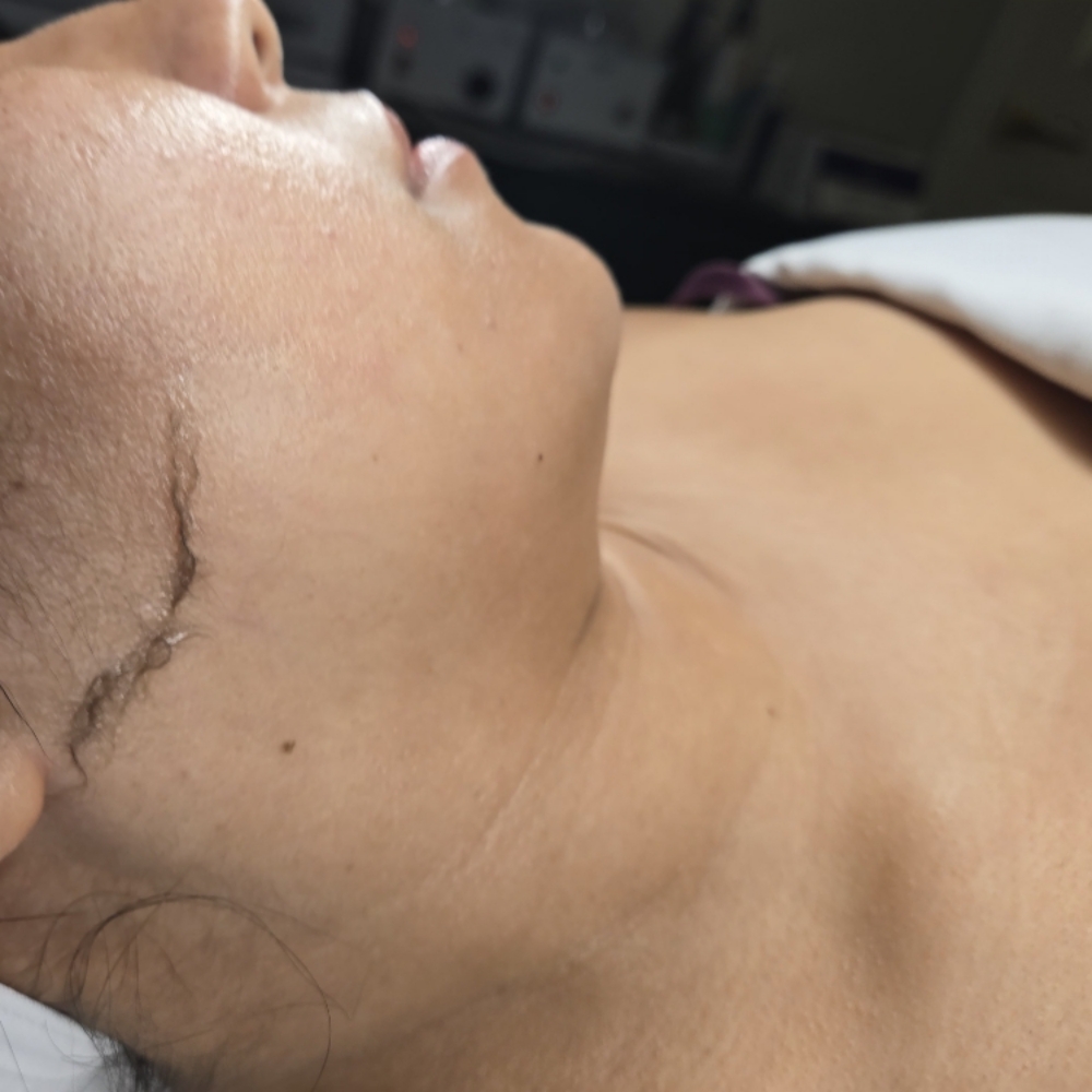 Dermaplaning at Midtown Esthetics in Raleigh, NC