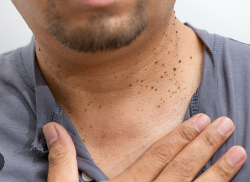 Removal of warts