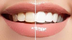 Teeth Whitening