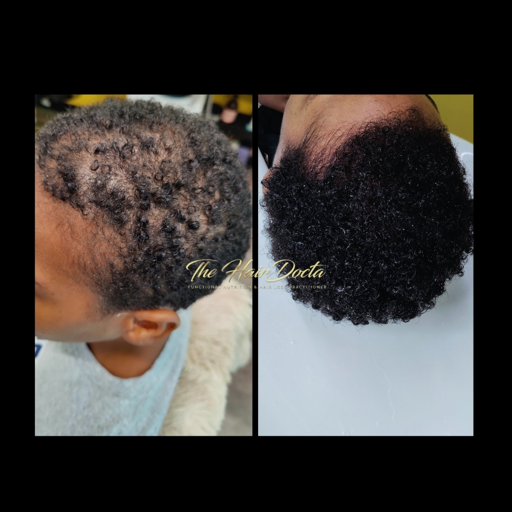 ⚠️Alopecia Maintenance Therapy