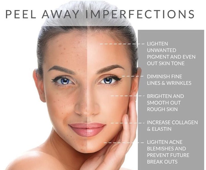 Chemical Peel