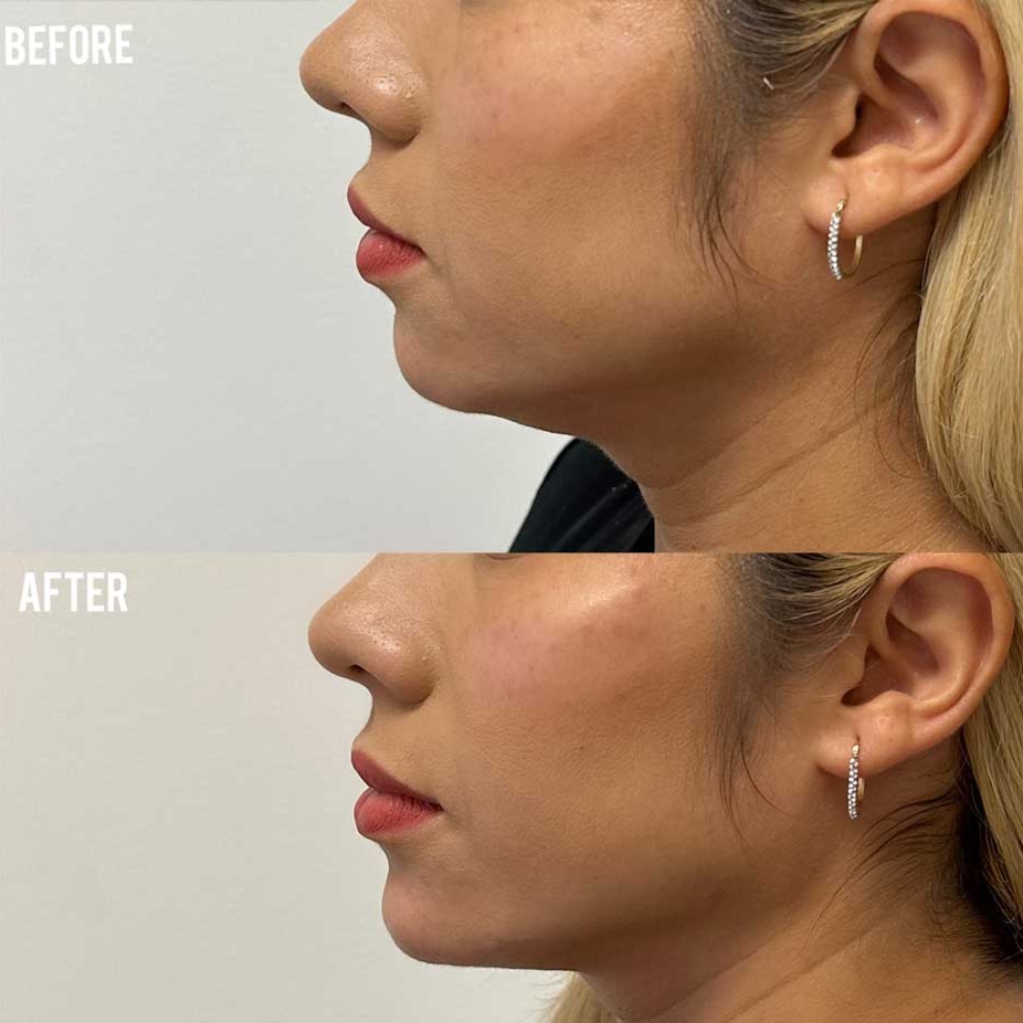 Facial Balancing (Cheek/Chin/Jaw) at Elevate Wellness and Weight Management in Wichita Falls, TX